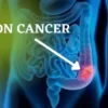 Know about colon cancer