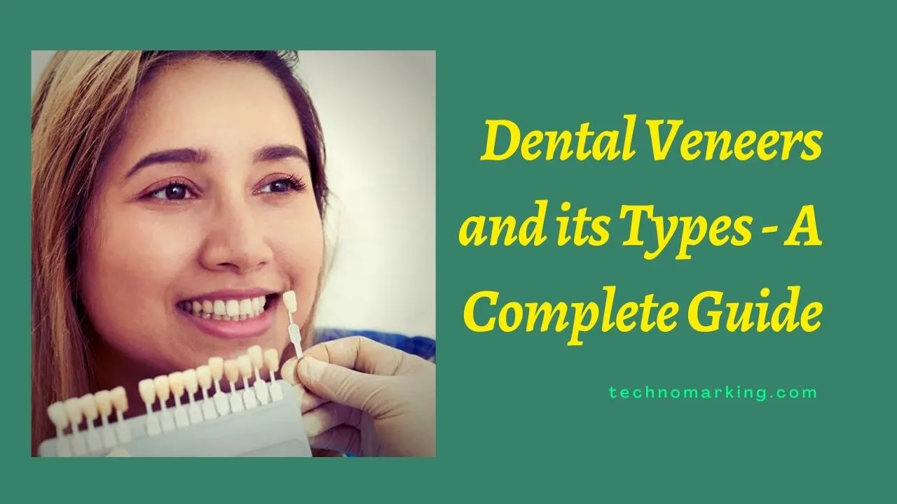 Dental Veneers and its Types – A Complete Guide