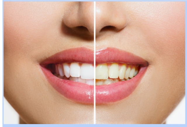 5 Must-Have Products for Maintaining Whiter Teeth