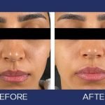 Experience the Ultimate Skin Rejuvenation with Fotona 4D Laser: The Future of Aesthetics