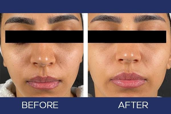 Experience the Ultimate Skin Rejuvenation with Fotona 4D Laser: The Future of Aesthetics