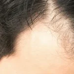 How to Stop Alopecia Areata from Spreading?