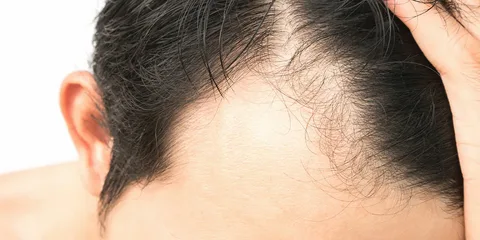 How to Stop Alopecia Areata from Spreading?
