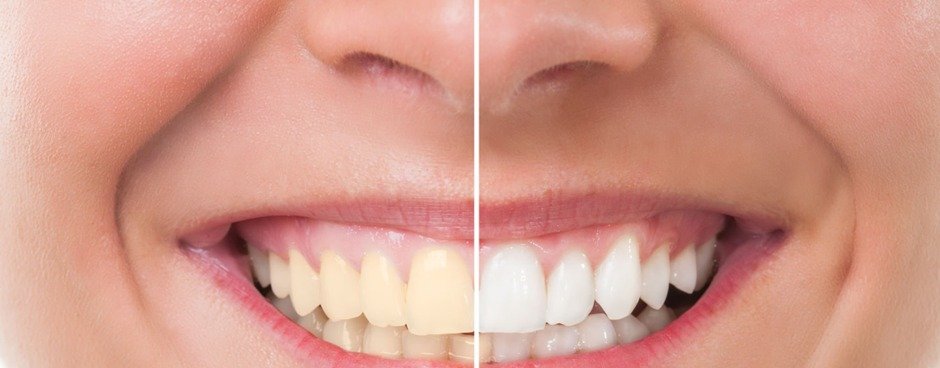 Improve the Health and Appearance of Your Teeth with Teeth Whitening
